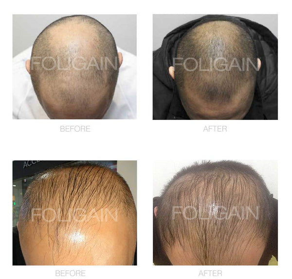 FOLIGAIN Advanced Hair Regrowth Treatment Foam For Men with Minoxidil 5% - FOLIGAIN UK