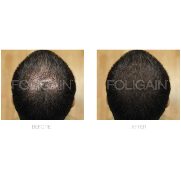 FOLIGAIN Minoxidil 5% Hair Regrowth Treatment For Men 12 Month Supply - FOLIGAIN UK